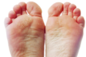 Еритемо-сквамозна форма на гъбички