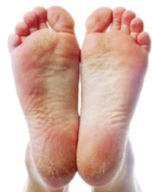 Еритемо-сквамозна форма на гъбички