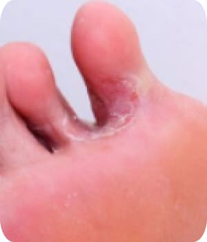 Интертригинозна форма на гъбички