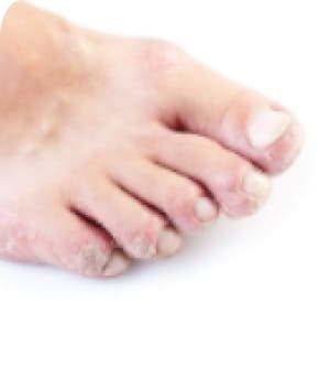 Дисхидротична форма на гъбички