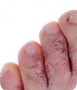 Остра форма на гъбички