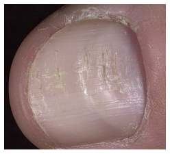 Uñas deformadas