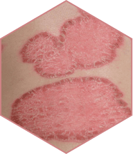 Démangeaisons Psoriasis
