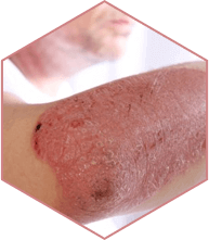Rejet social Psoriasis