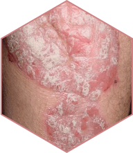 Isolement Psoriasis