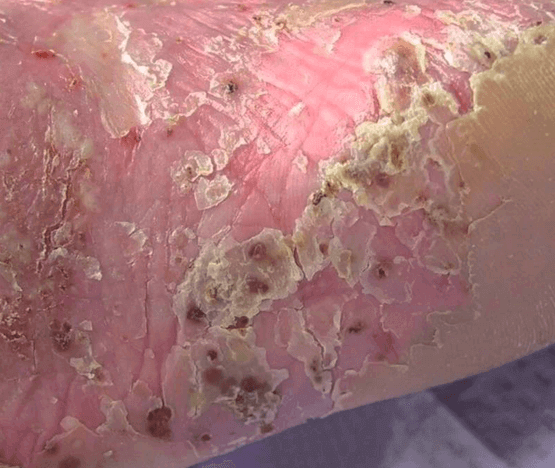Psoriasis Avant