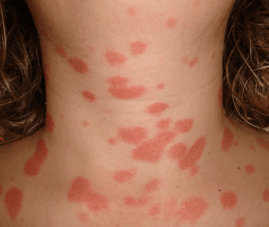 Psoriasis Après