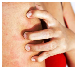 Állandó Viszketés Lábgomba