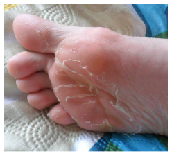 Hámló Bőr Lábgomba