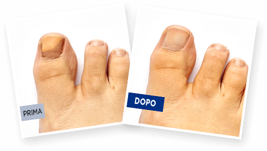 Prima e Dopo Exodermin