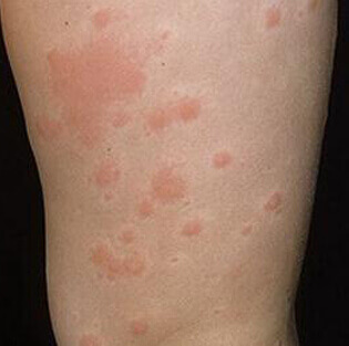 Allergie Micosi